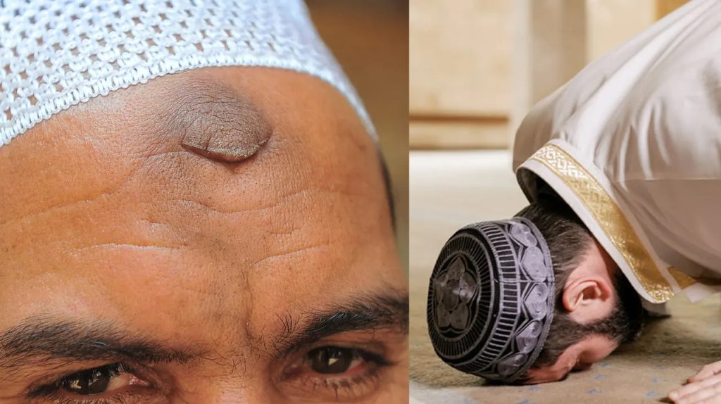 নামাজ পড়তে পড়তে কপালে দাগ ওঠা কি নেককার হওয়ার লক্ষণ?