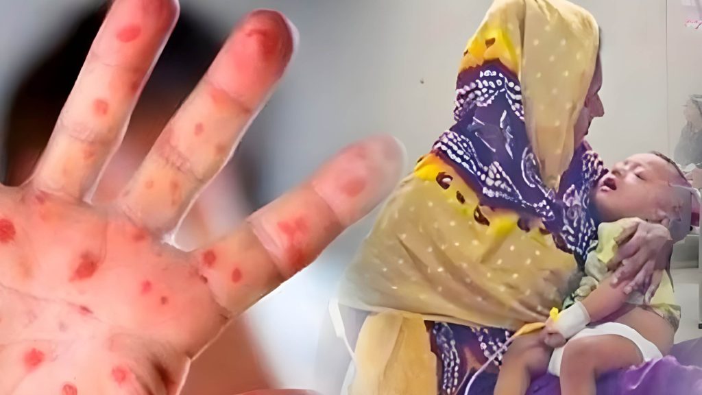 হাম ও হামের উপসর্গ নিয়ে একদিনে সর্বোচ্চ ১৭ জনের মৃত্যু